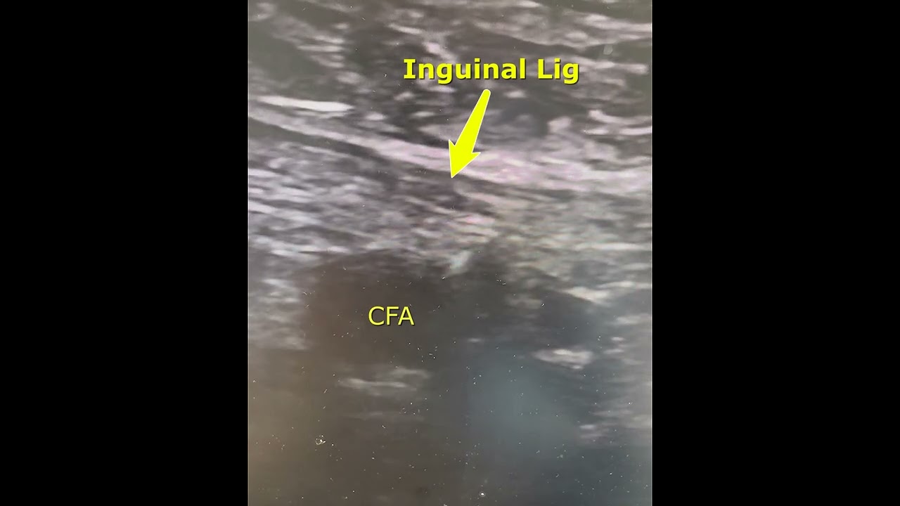 Practice Tips with Dr. Lichaa: The Importance of Identifying the Inguinal Ligament in Ultrasounds