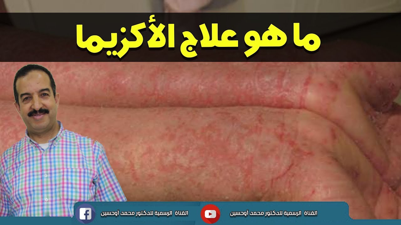 ما هو علاج الأكزيما / الدكتور محمد أوحسين
