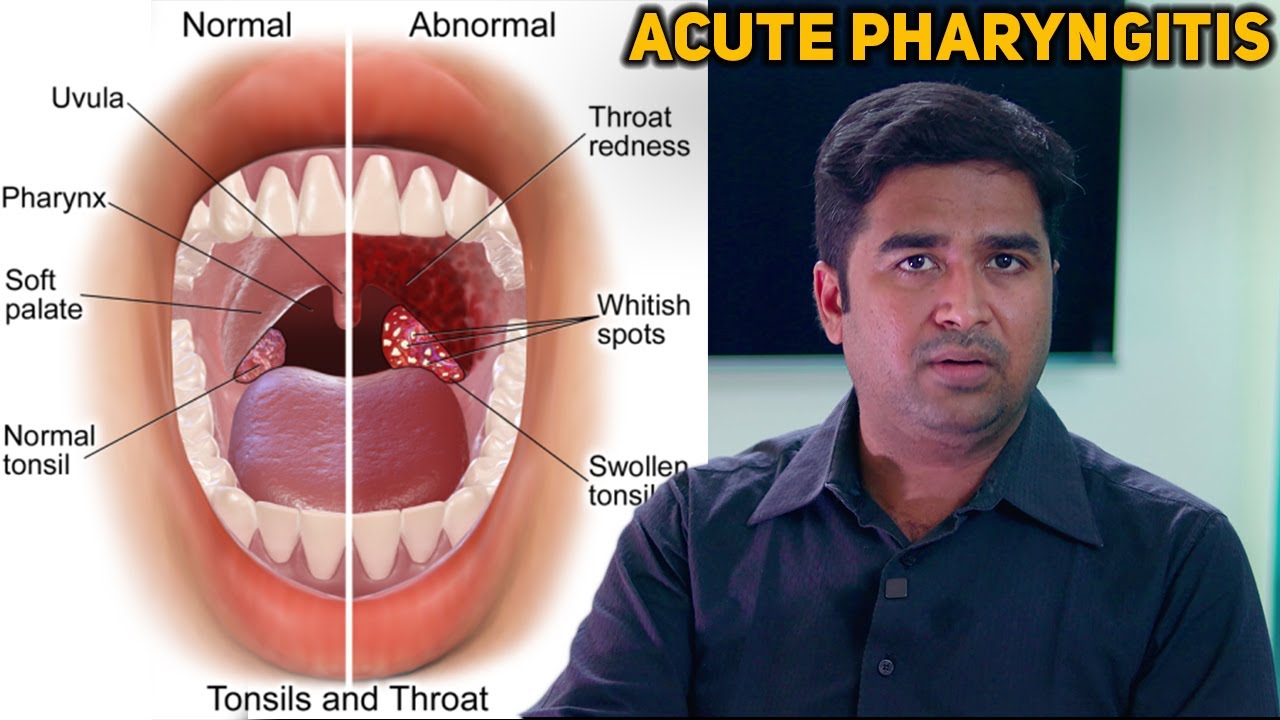 Is Acute Pharyngitis Serious?|அக்யூட் ஃபரிங்கிடிஸ்' ஆபத்தானதா?| Dr. Vignesh Gokul ENT Doctor
