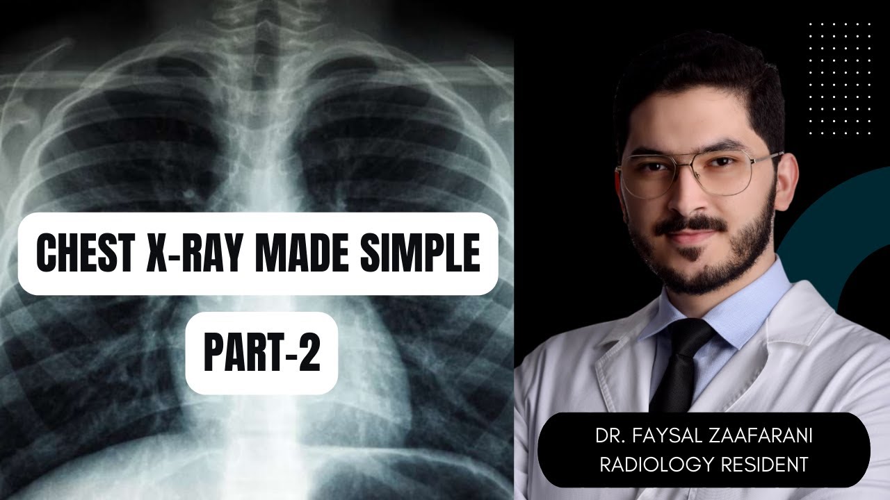 اشعة الصدر بدون تعقيد (2) Chest X-ray Made Simple