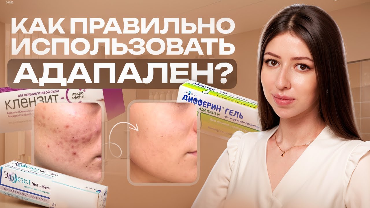 Как ПРАВИЛЬНО наносить адапален (Эффезел/Клензит/Дифферин) и не допустить раздражения?