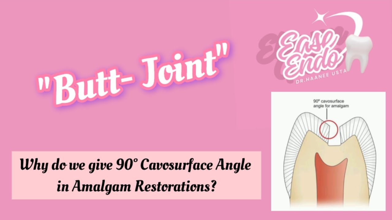 Cavosurface Angle in Amalgam Restoration - 