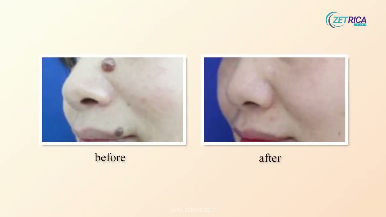 ZET FRAX ULTRA PULSE 60W CO₂ Fractional Laser | Best Skin Resurfacing Machine for Clinics
