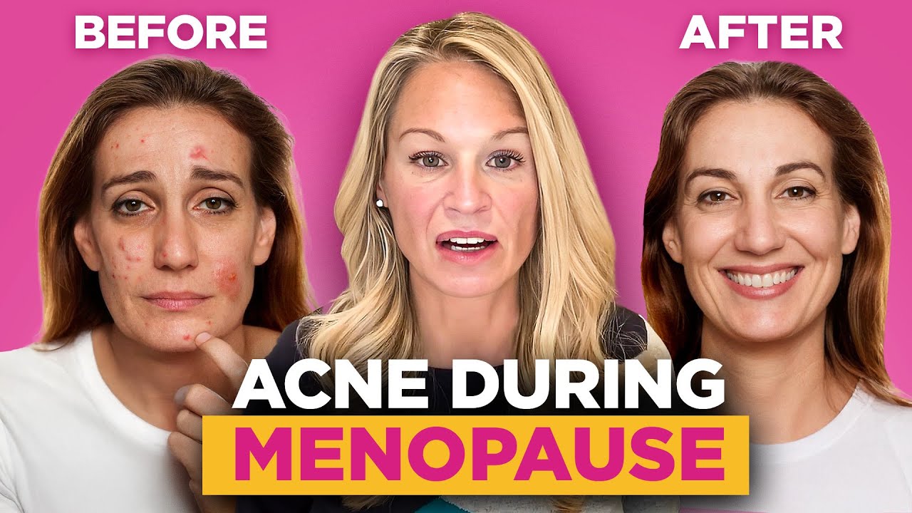 Surprising Acne Menopause and How to Treat It | Skin Related Menopause Symptoms