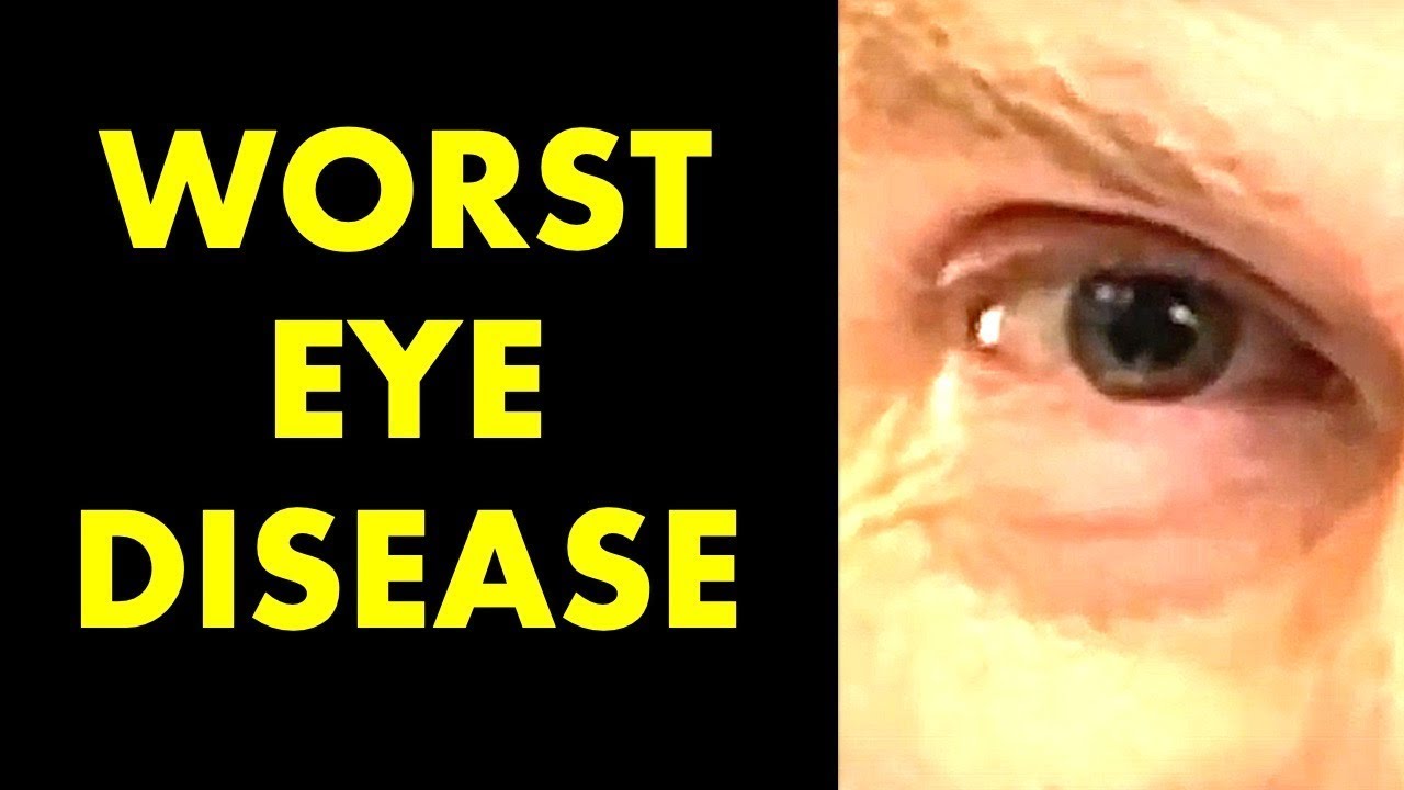 UNDERSTAND Dry Macular Degeneration? Discover the Secrets!