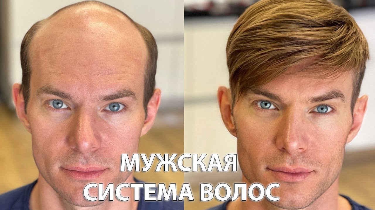 Алопеция у мужчин. Накладка из волос. До и после