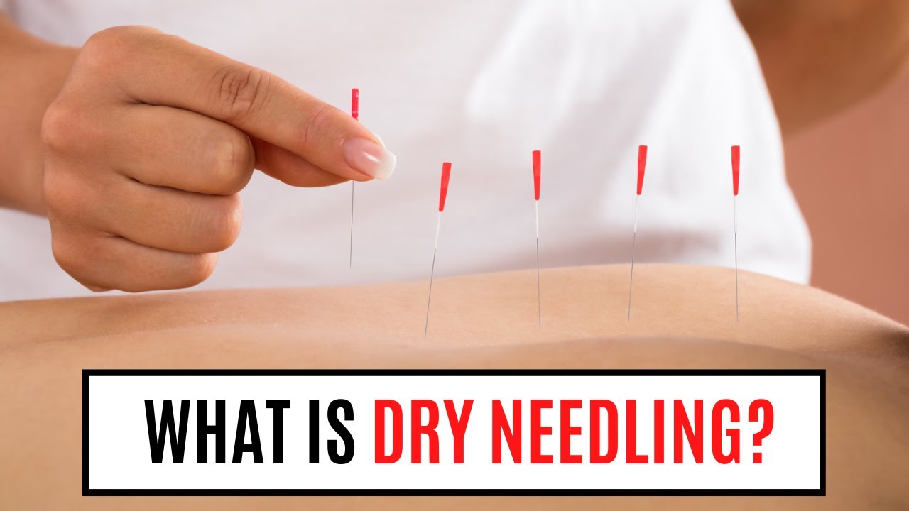 What Is Dry Needling?