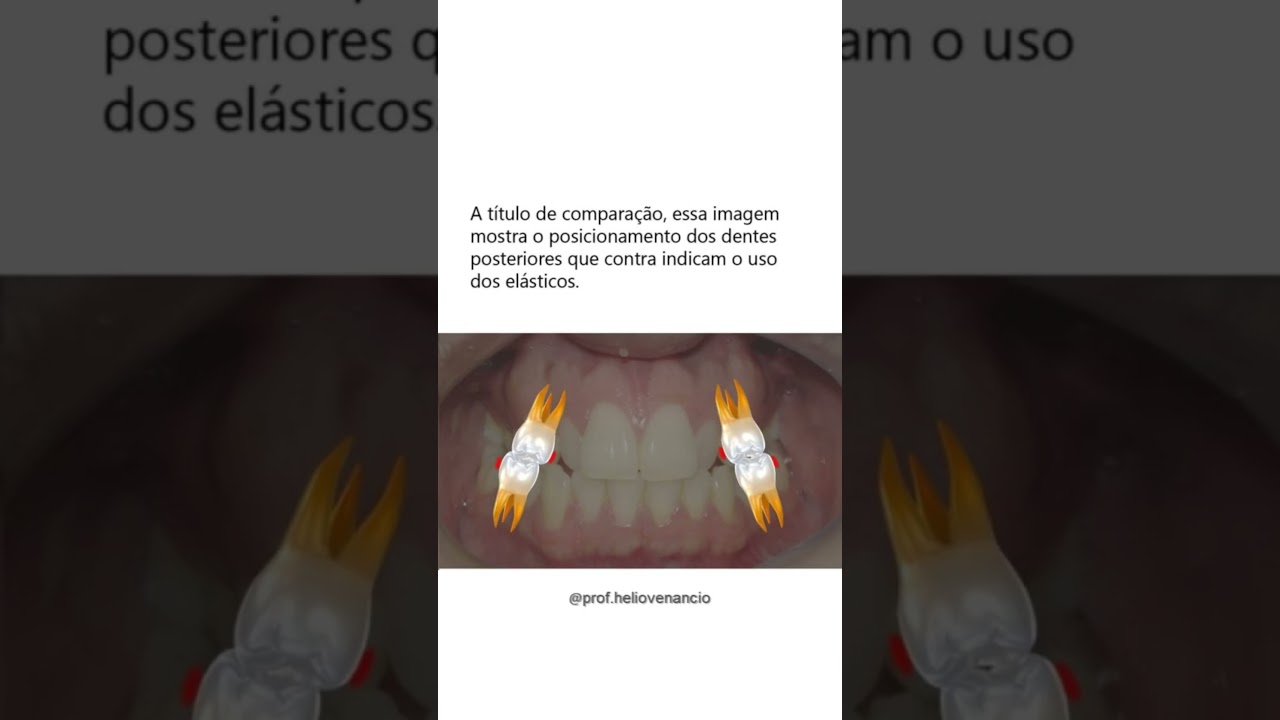 Voc&ecirc; usa el&aacute;sticos para descruzar a mordida posterior?  Veja como eu fa&ccedil;o 👉