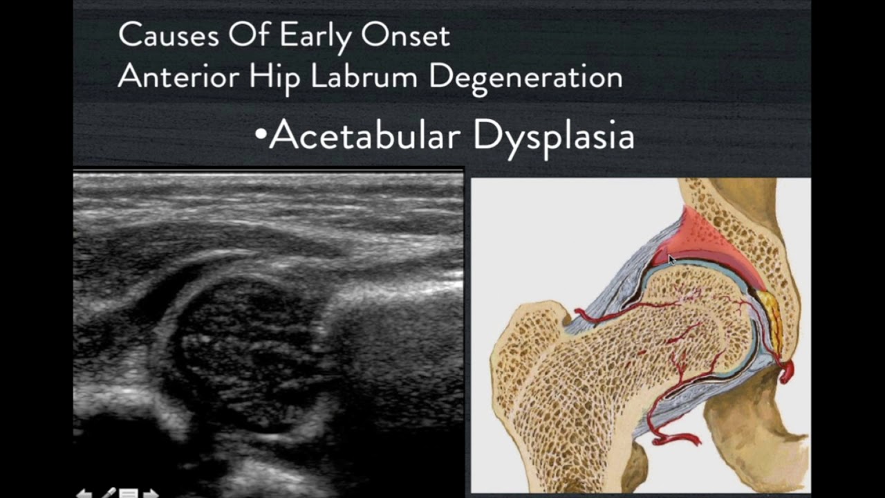 Comprehensive Hip Ultrasound   Archive Edition