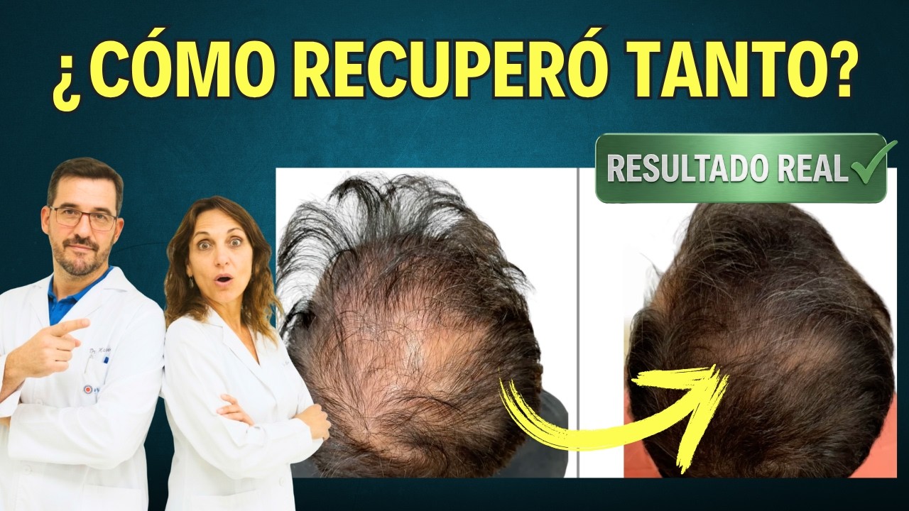 🟠 Este TRATAMIENTO CAMBIO su INJERTO CAPILAR