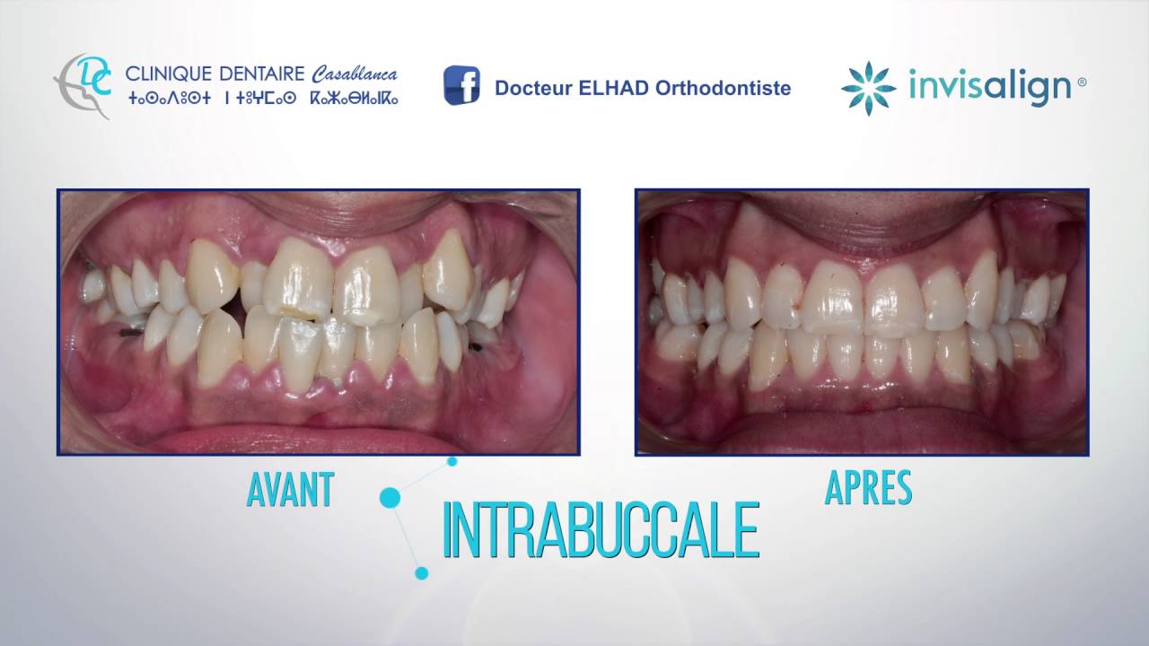 #‎invisalign‬ : l'alternative invisible aux bagues orthodontiques
