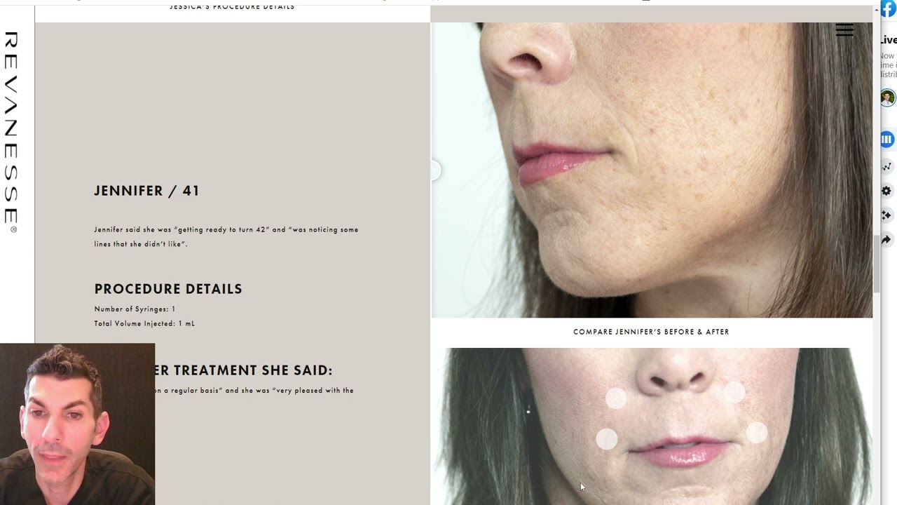 Introducing two new fillers:  Revanesse Versa and Lips+ and discussion of fillers & lip enhancement