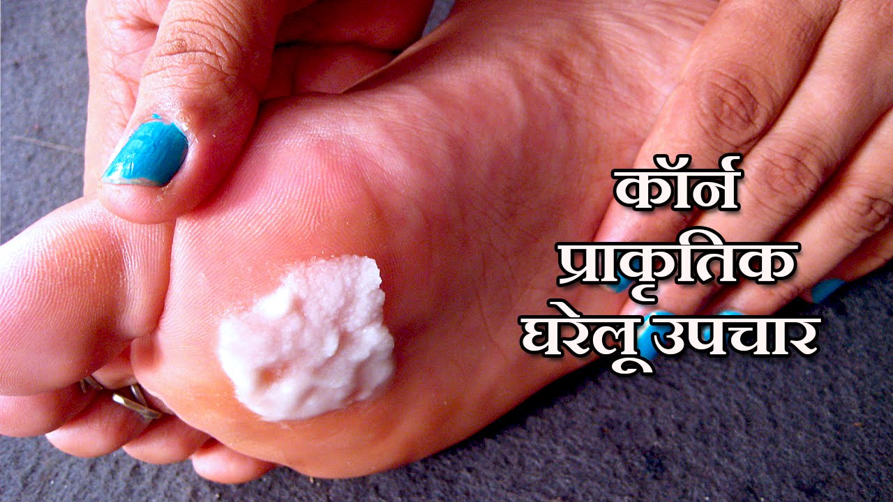 कॉर्न के उपचार, पैर का गोखरू कैसे ठीक करें, Corn ka ilaj, How To Remove Foot Corn