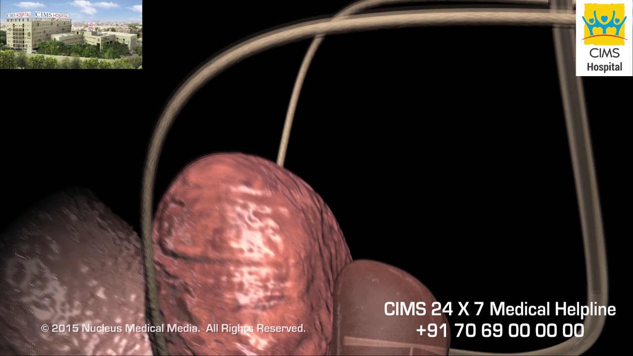 Transurethral Resection of the Prostate TURP (Hindi) - CIMS Hospital