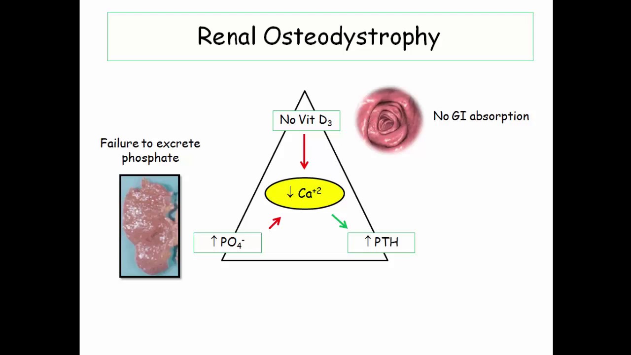 12DaysinMarch, Renal Osteodystrophy for the USMLE Step One