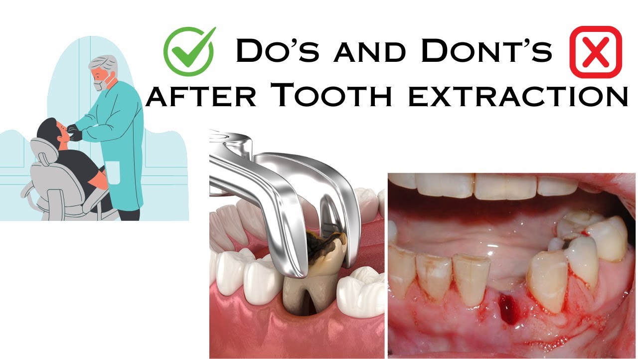 DO'S AND DONT'S AFTER TOOTH REMOVAL | POST EXTRACTION INSTRUCTIONS | DENTO FRIEND #dentalextraction