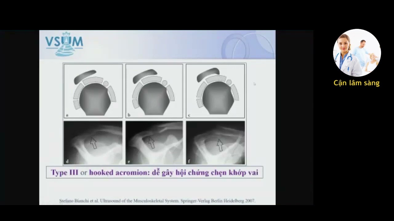 SIÊU ÂM KHỚP VAI | Bs. NGUYỄN QUANG TRỌNG