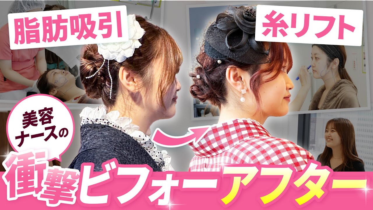 【衝撃のビフォアフ】美容ナースが糸リフト＋脂肪吸引で小顔に！！ひょうたん型の輪郭を卒業するまでの全記録【湘南美容クリニック/若返りエキスパートドクター高橋承子】