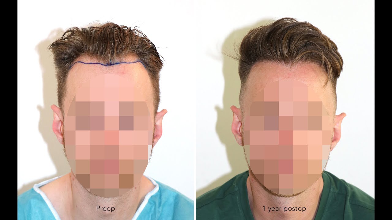 FUE Hair Transplant Receding Hairline Before After | 1933 FUs | Dr. Feriduni