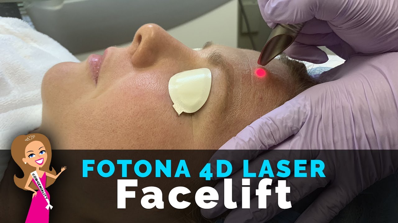 What Does Fotona 4D Laser Feels Like? | Laser FACELIFT | Laser Skin Tightening | Build Collagen