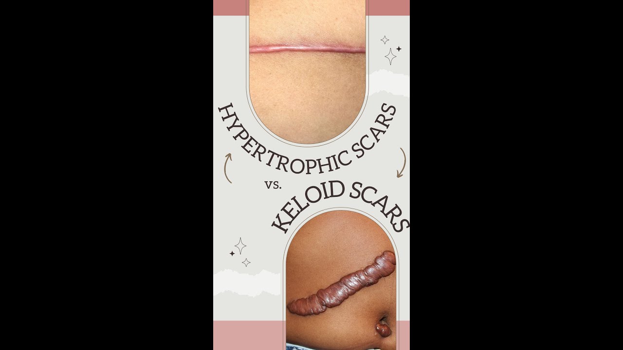 Hypertrophic Scars vs Keloid Scars: How to Tell the Difference & What to Do About Them