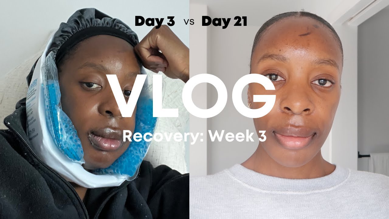 VLOG #15: Week 3 After Double Jaw Surgery - GOODBYE Severe Swelling + Scars, Skincare & A Sore Jaw