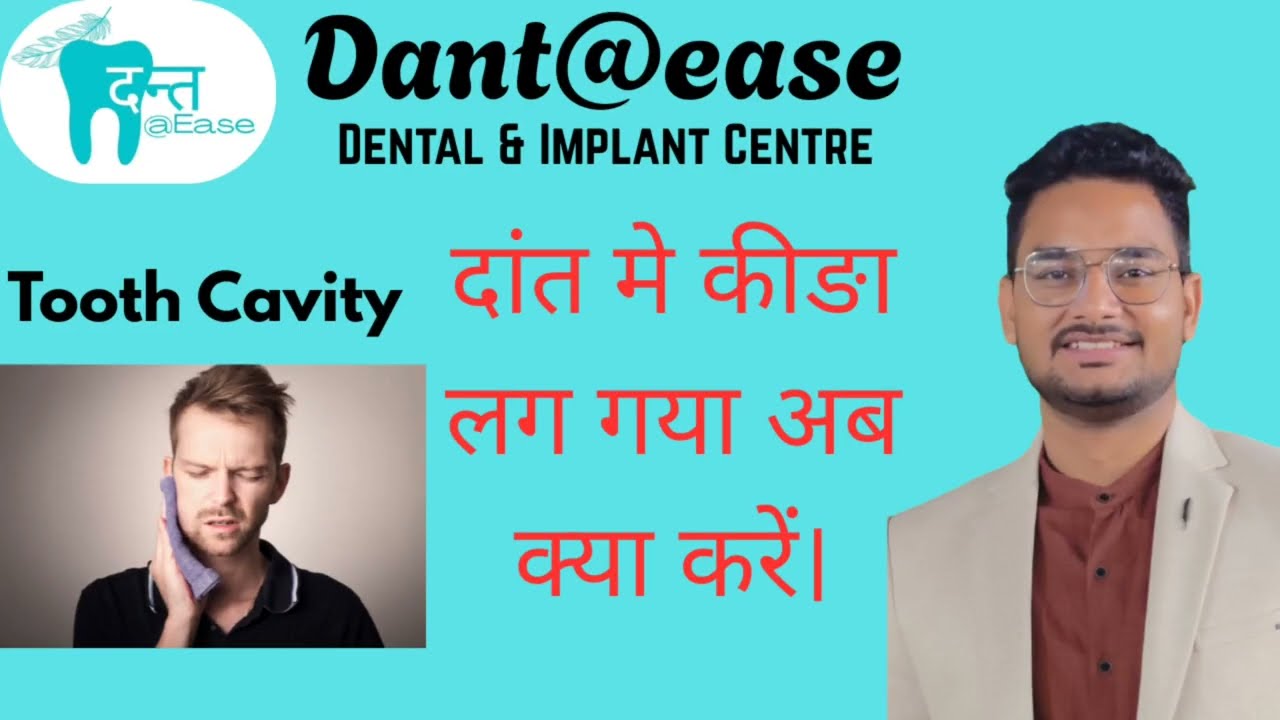 Tooth cavity #dental #dentist #toothcoloredfilling #oralhygiene 