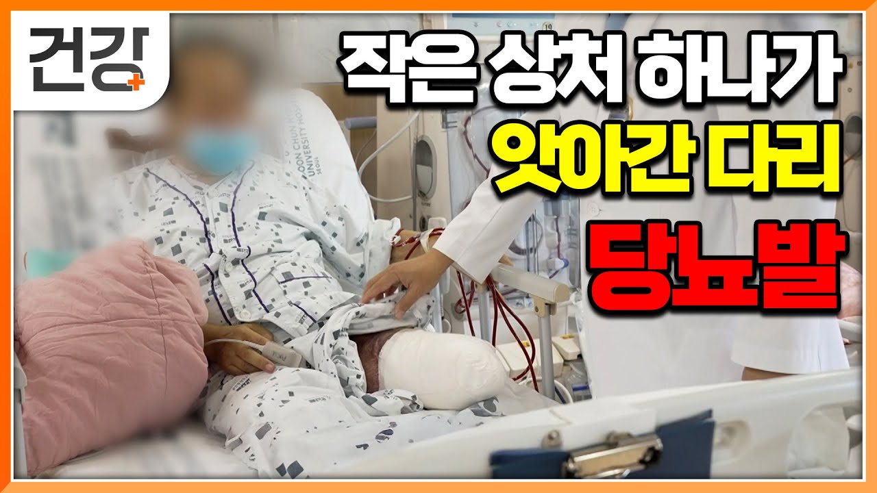 당뇨병 환자&nbsp;5명 중&nbsp;1명이 겪는 비극, 당뇨발. 작은 상처를 무시하면 안 되는 이유│명의│#EBS건강