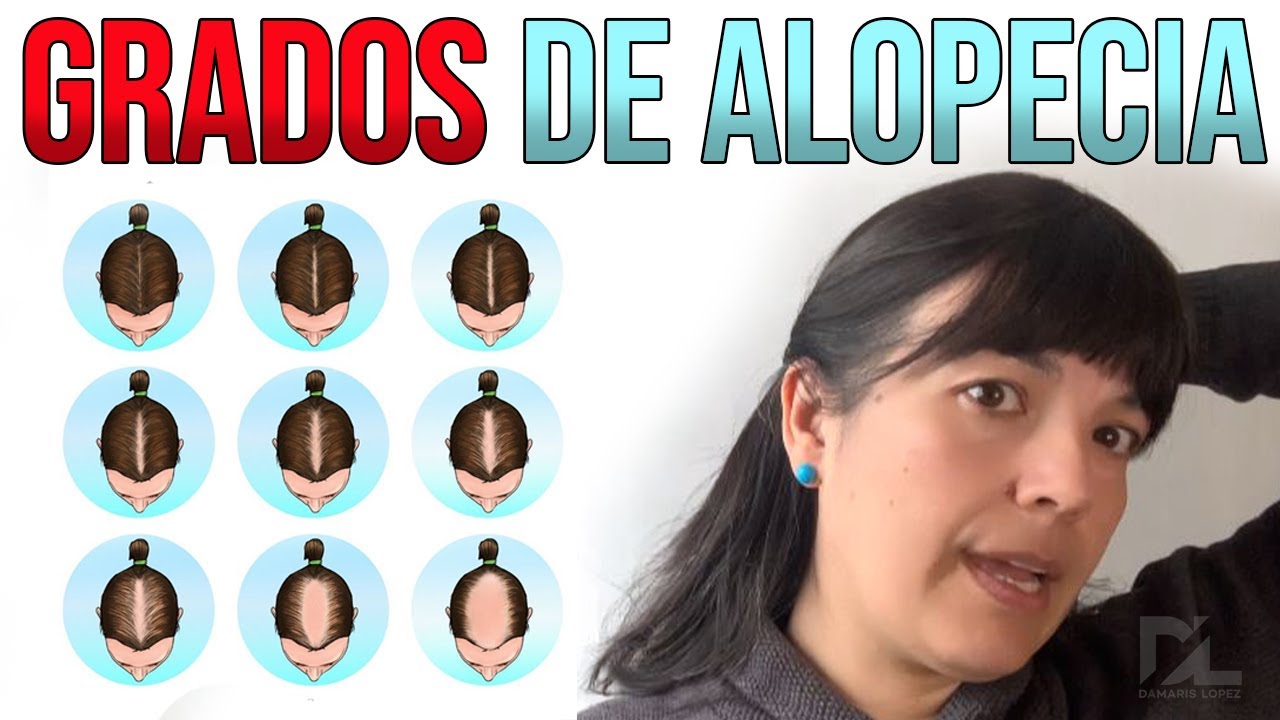 😥GRADOS DE ALOPECIA Y PRÓTESIS CAPILAR | PELUCA | TOPPER DE CABELLO | GUIA