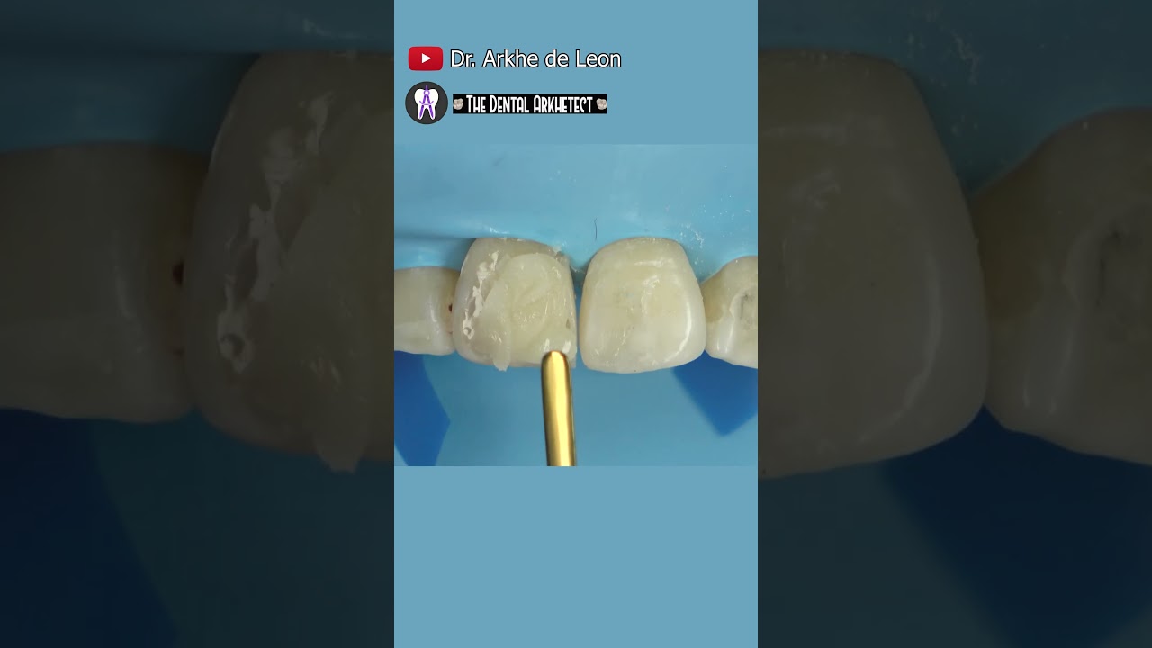 Restoring Patient's Confidence #dental #toothfilling #dentist #toothrestoration #dentistry
