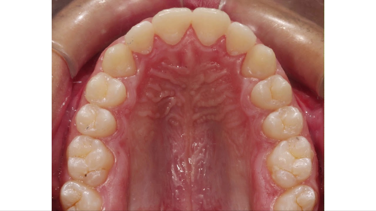 HOW TO MANAGE PROPERLY THE TRANSVERSAL DIMENSION WITH ALIGNERS