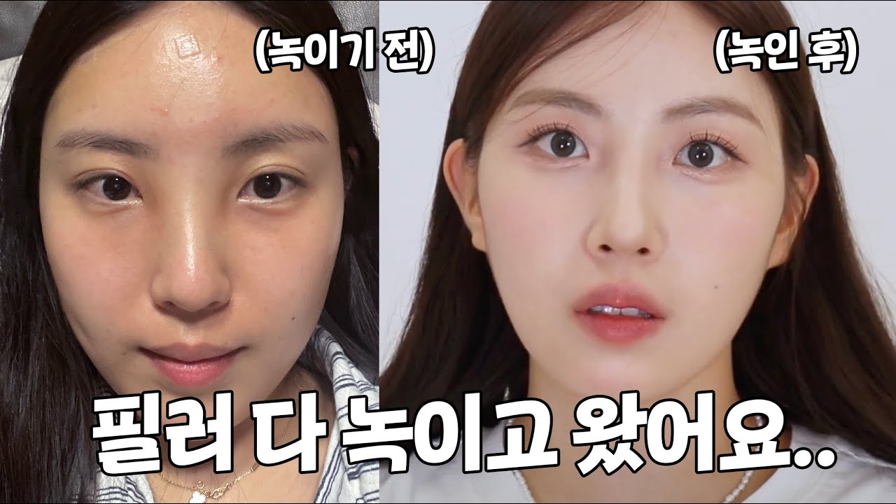 필러 전 필수시청‼️ 필러 현실판..시술 후 한 달만에 다 녹였어요😭 250만원 날림 (붓기, 부작용, 필러 녹이는 주사)
