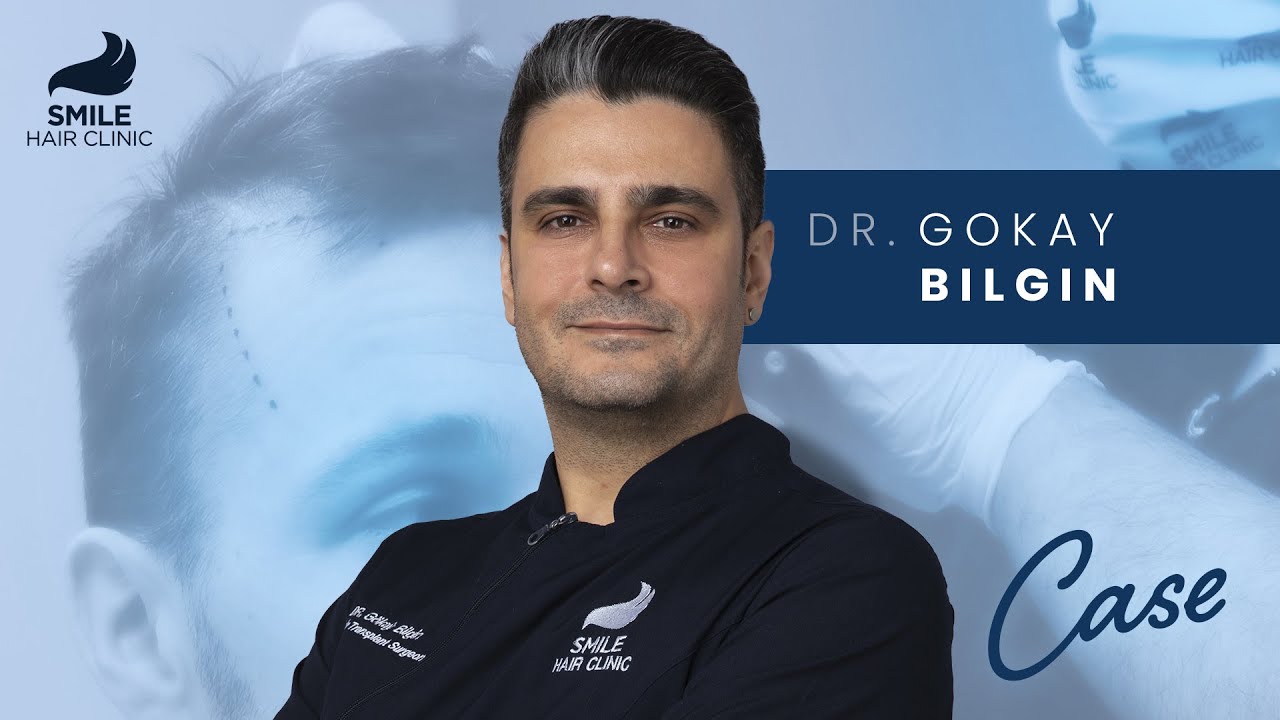 Hair Transplant Case Study: Bryan's 9-Month Results | 5300 GRAFTS | Smile Hair Clinic