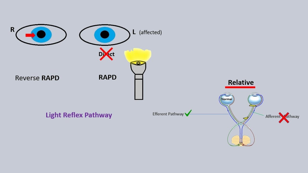 RAPD eye test | relative afferent pupillary defect | Marcus gunn pupil