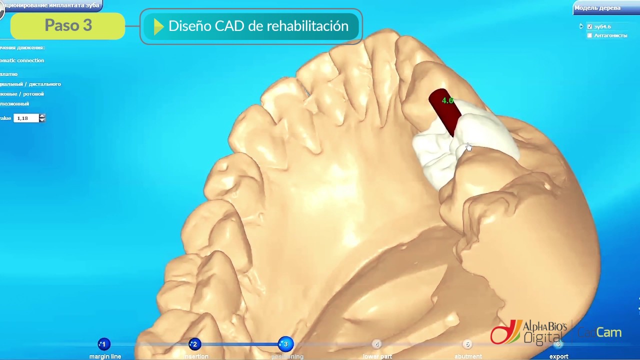 CAD CAM impresión intraoral  | Alpha-Bio Tec.
