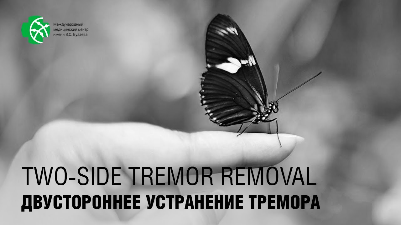 Двустороннее устранение тремора фокусированным ультразвуком.
