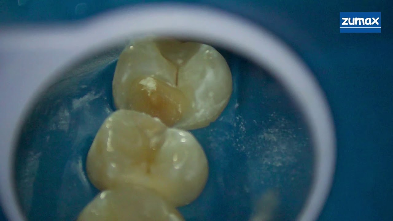 DIRECT PULP CAPPING