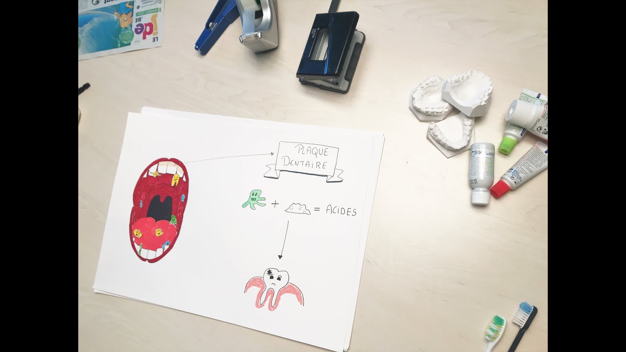 D'où viennent les caries? – Dessine-moi une actu (51)
