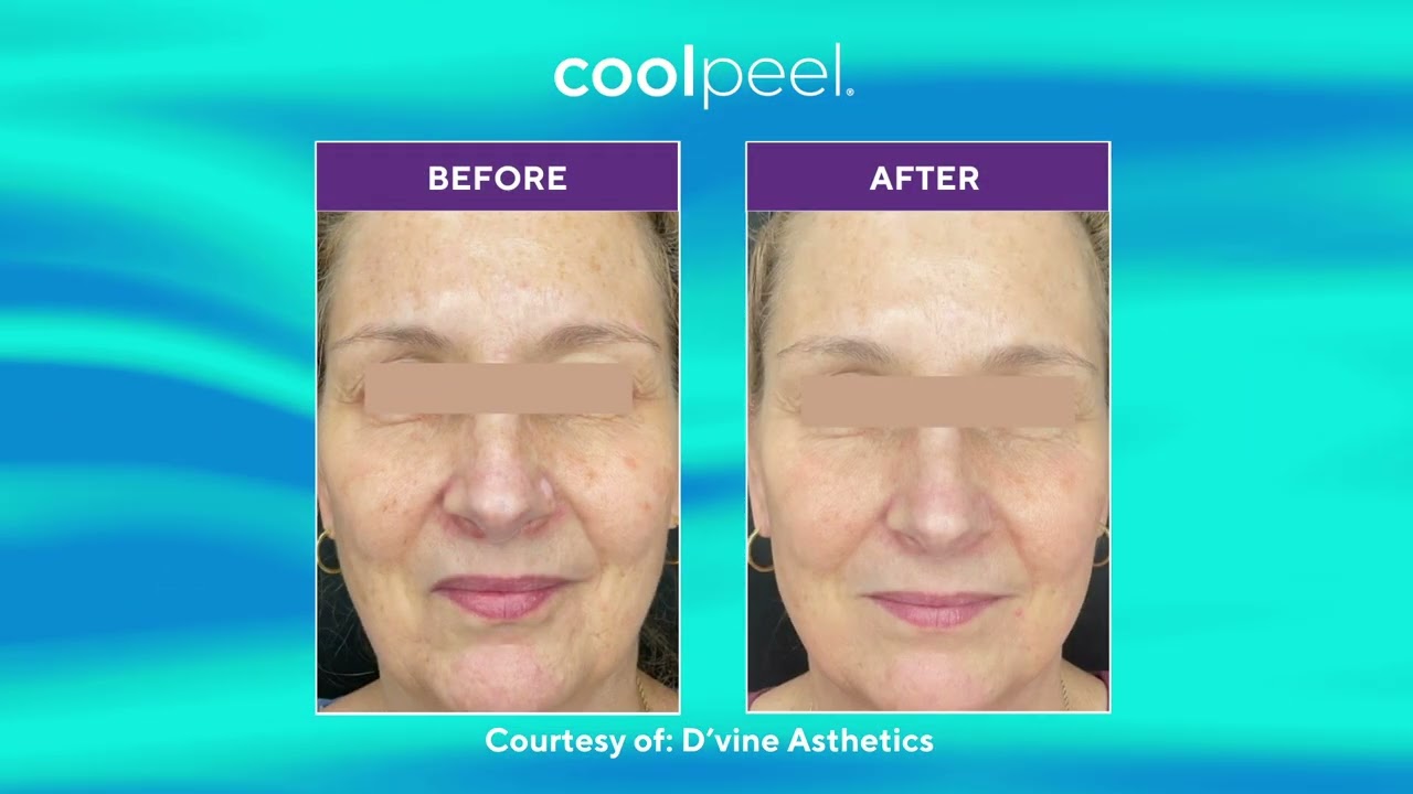 Everyone Is Talking About Tetra-PRO CoolPeel CO₂ Laser | Advanced Skin Rejuv in Costa Mesa & Newport