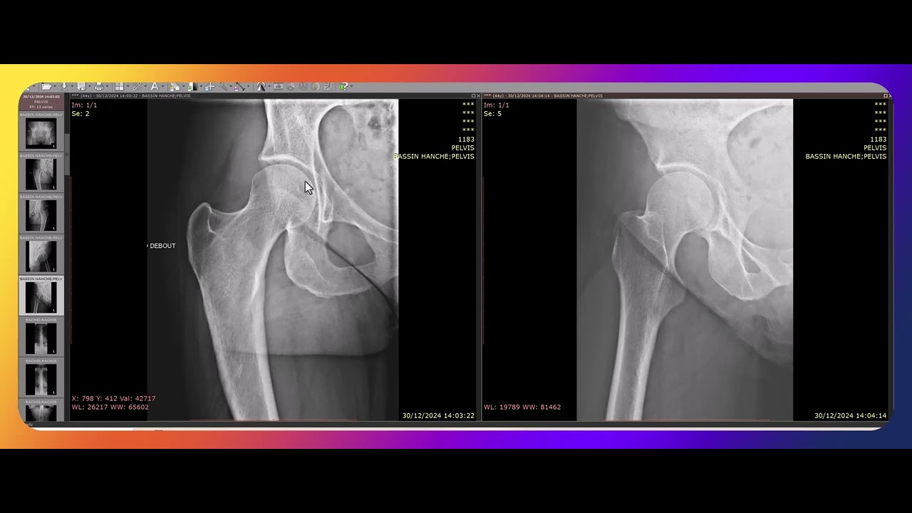 Comment interpr&eacute;ter une radiographie de la hanche ?