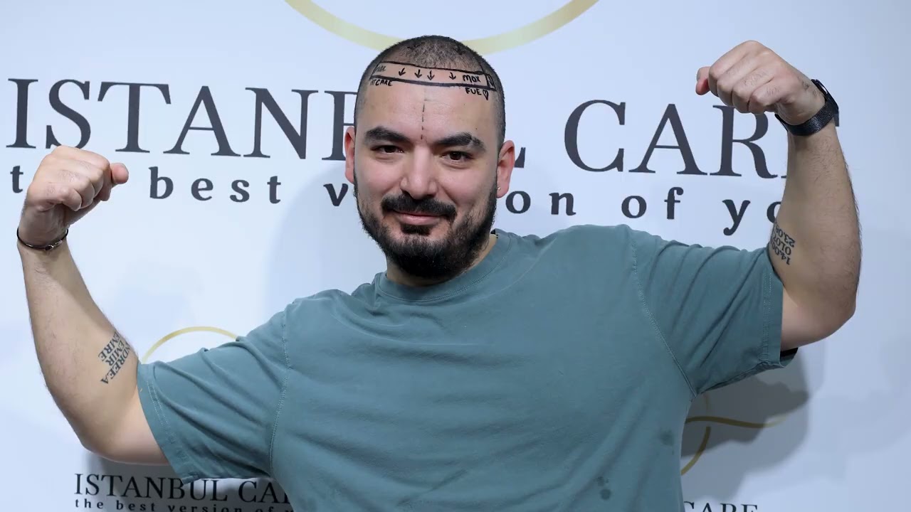 My Hair Transplant Journey in Turkey: From Arrival to Results | Istanbul Care Clinic