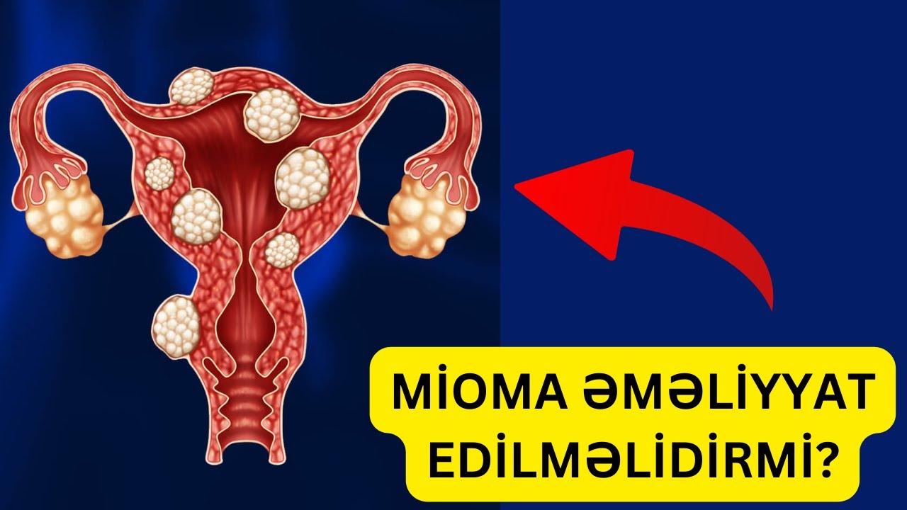 Miomalar - Nə vaxt əməliyyat edilir?
