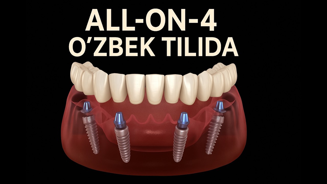 All on 4 o`zbek tilida Impant tishlar orqali yechim turlari va narxlari