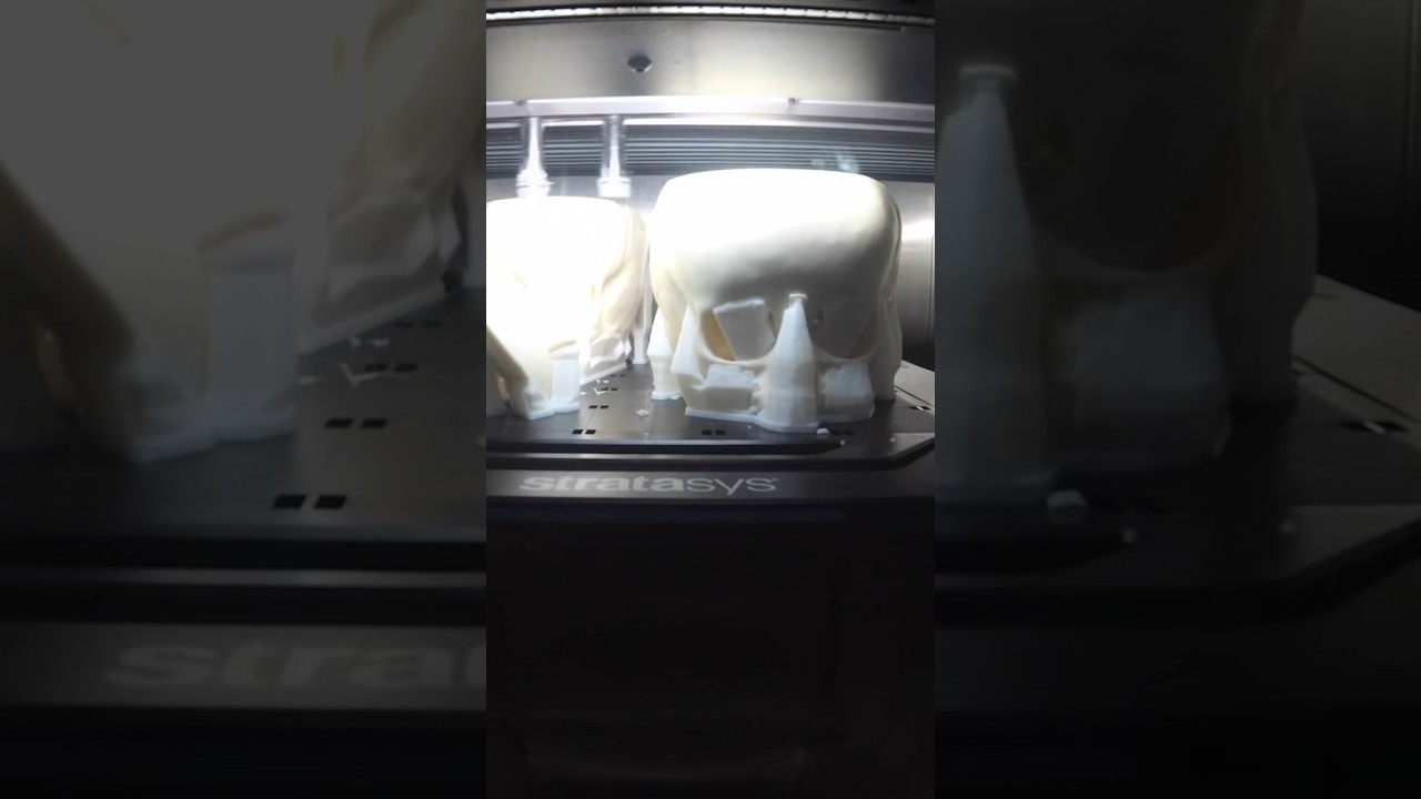 Conjoined twins separation planned using 3D printed models