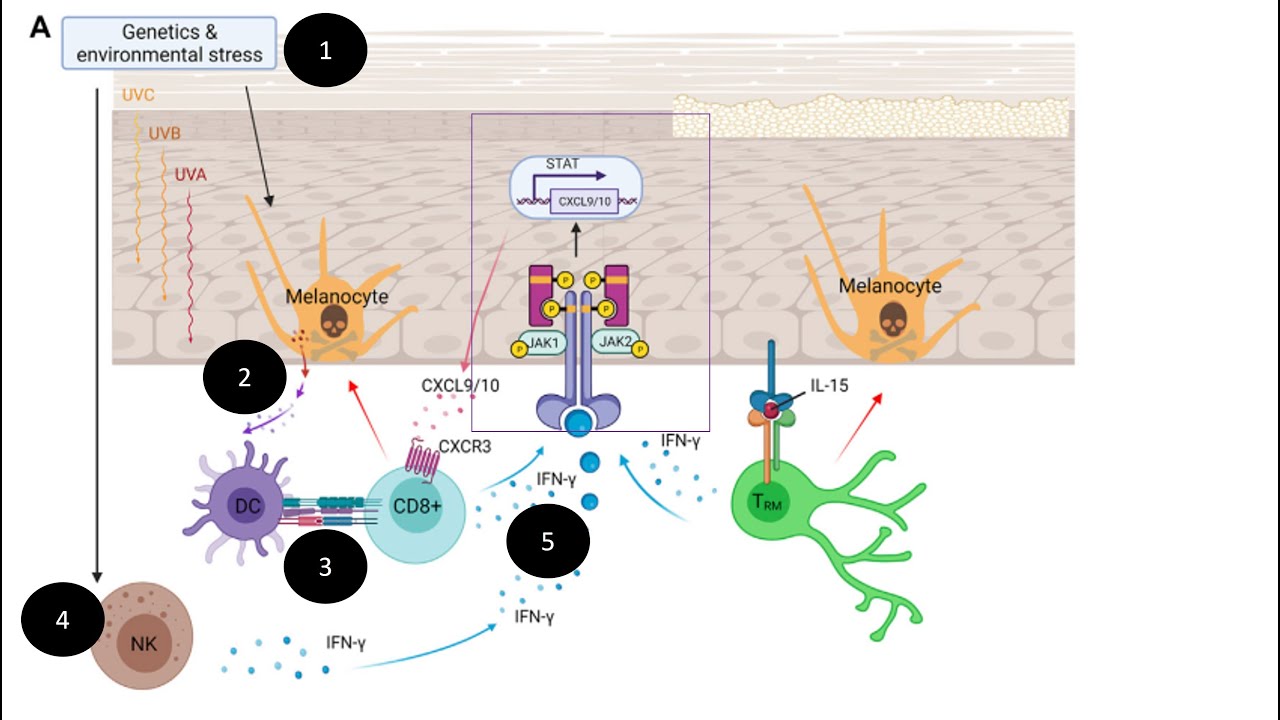 JAK inhibitors  in Vitiligo