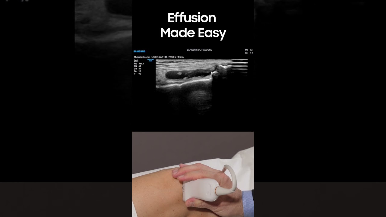 Spot Knee Fluid in Seconds with Ultrasound