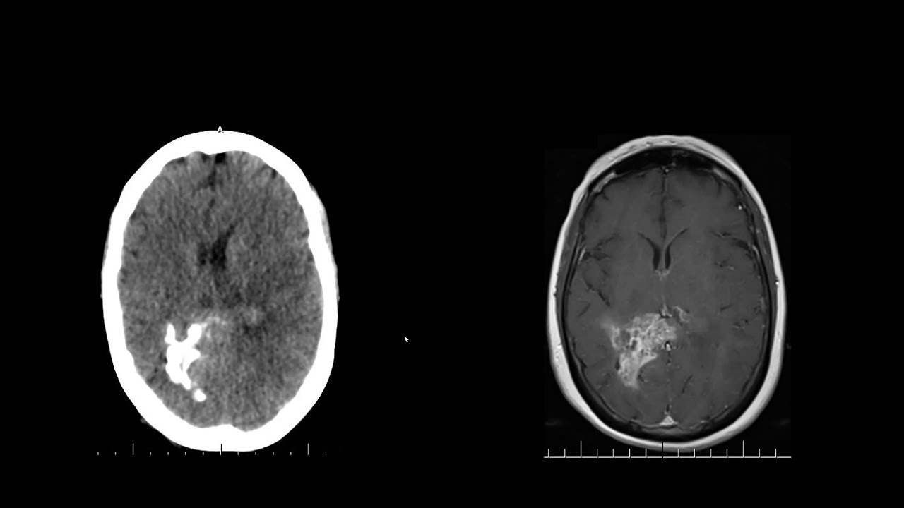 Casos Clínicos de Neurología y neurocirugía - Parte 1
