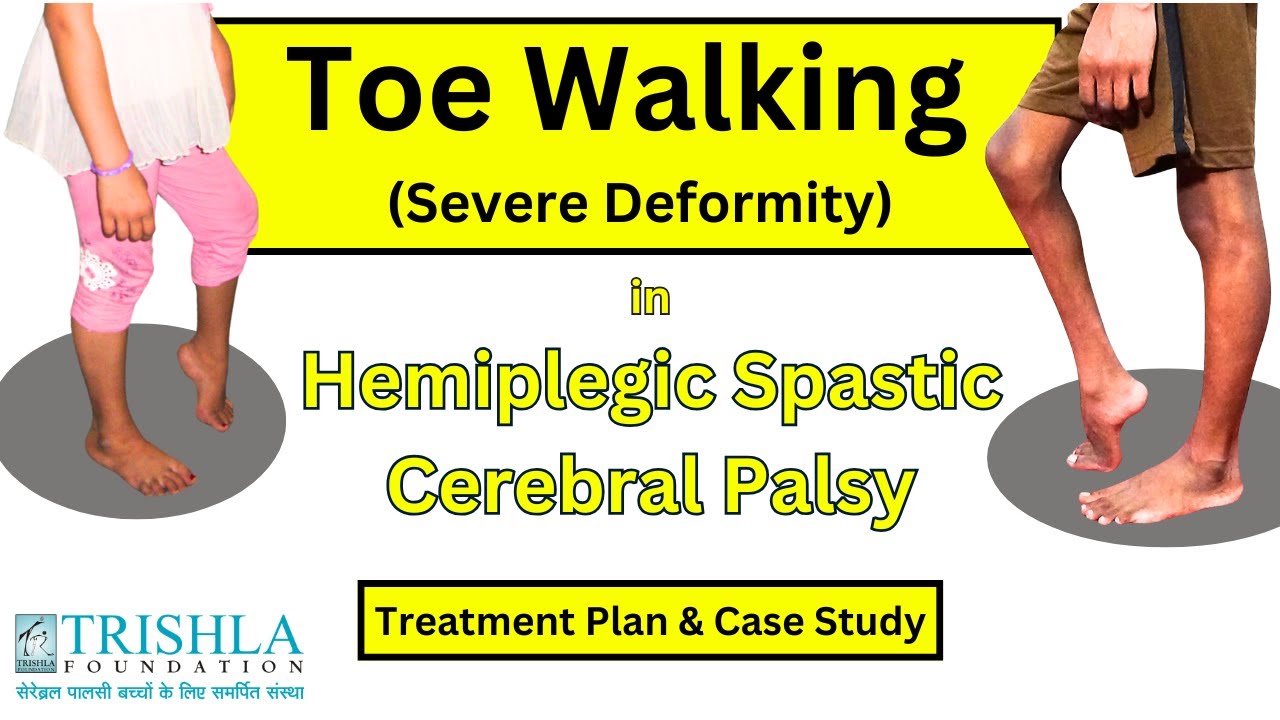 Hemiplegic Spastic CP & Tiptoe Walking: Causes, Treatment & Case Study | Trishla Foundation