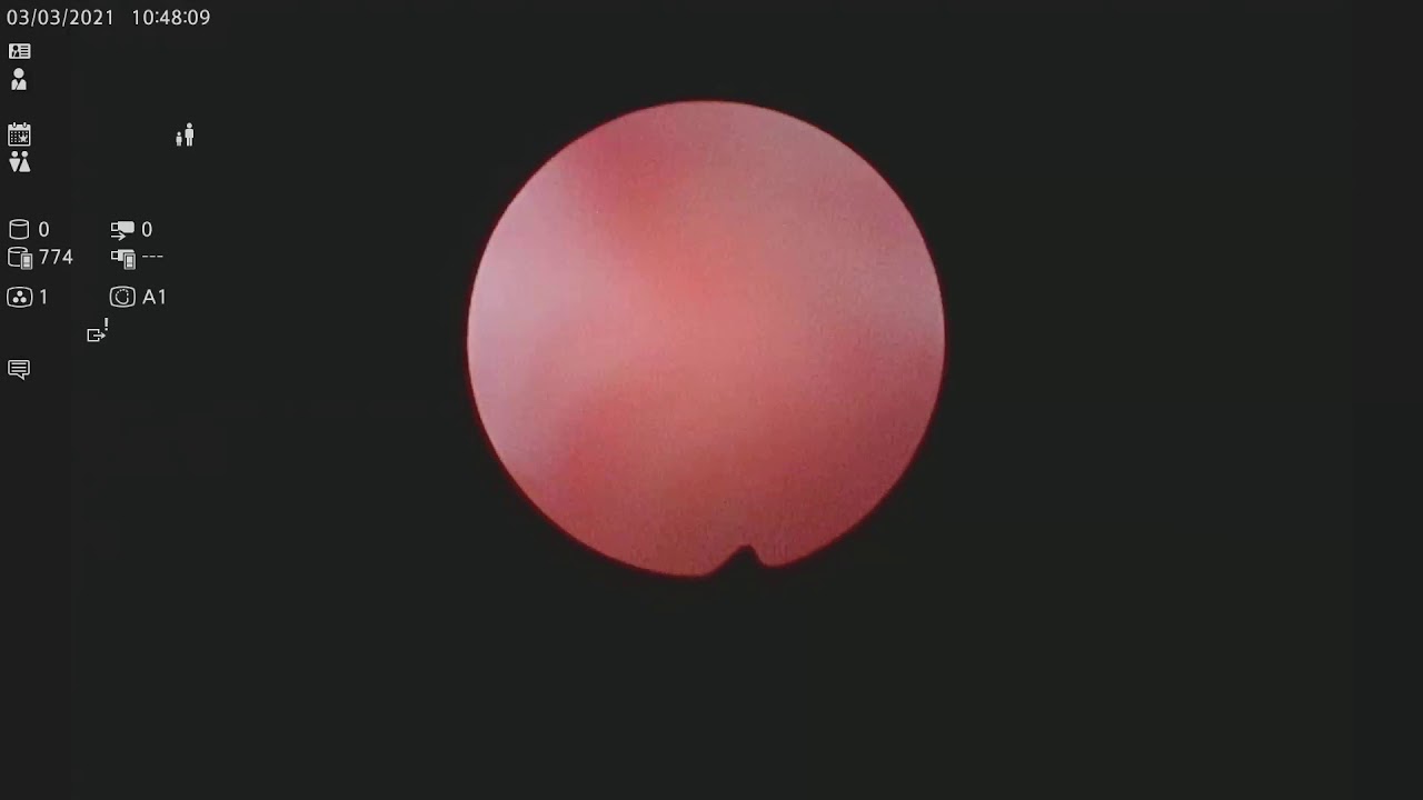 MiniPCNL, 16F,  Litotrypsja z użyciem lasera.