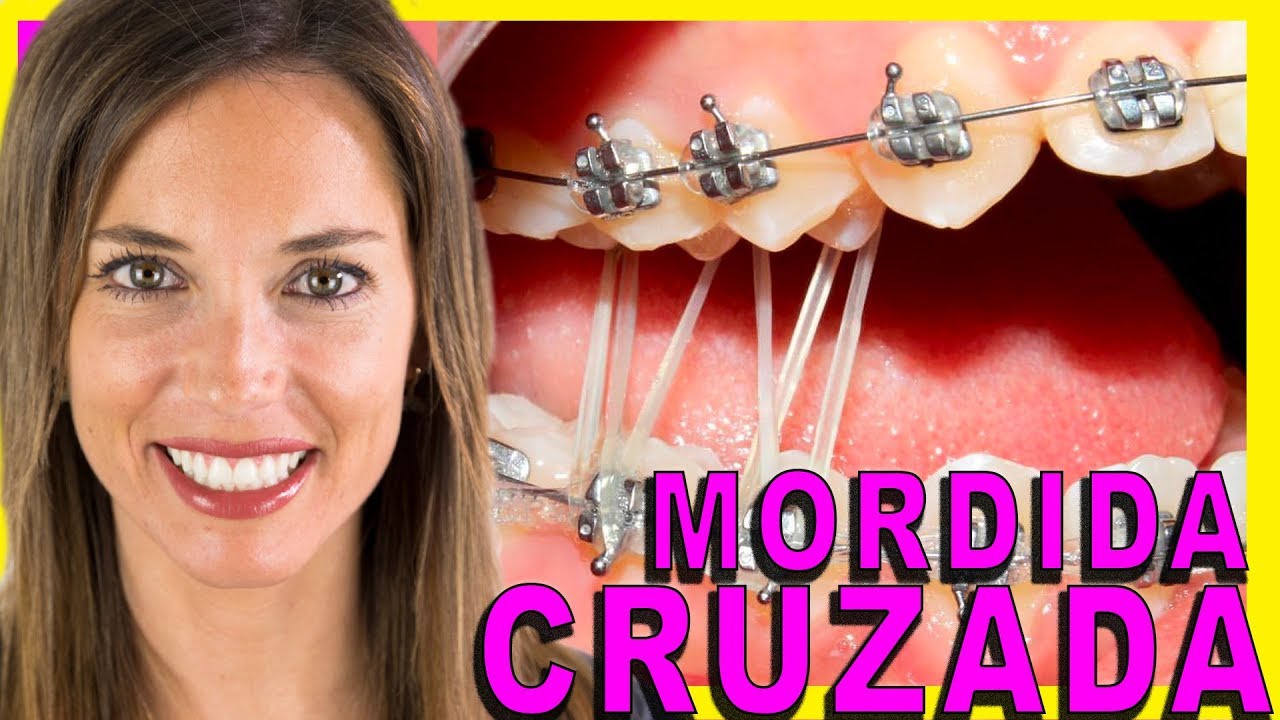 🖍📗𝑬𝑳𝑨𝑺𝑻𝑰𝑪𝑶𝑺 𝑰𝑵𝑻𝑬𝑹𝑴𝑨𝑿𝑰𝑳𝑨𝑹𝑬𝑺  mordida CRUZADA posterior- GOMAS triaungulares en ORTODONCIA